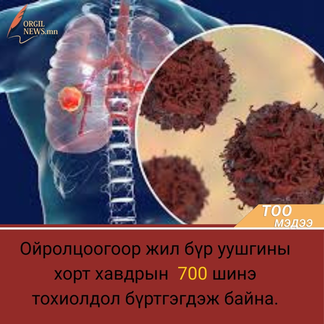 Ойролцоогоор жил бүр уушгины хорт хавдрын  700 шинэ тохиолдол бүртгэгдэж байна.